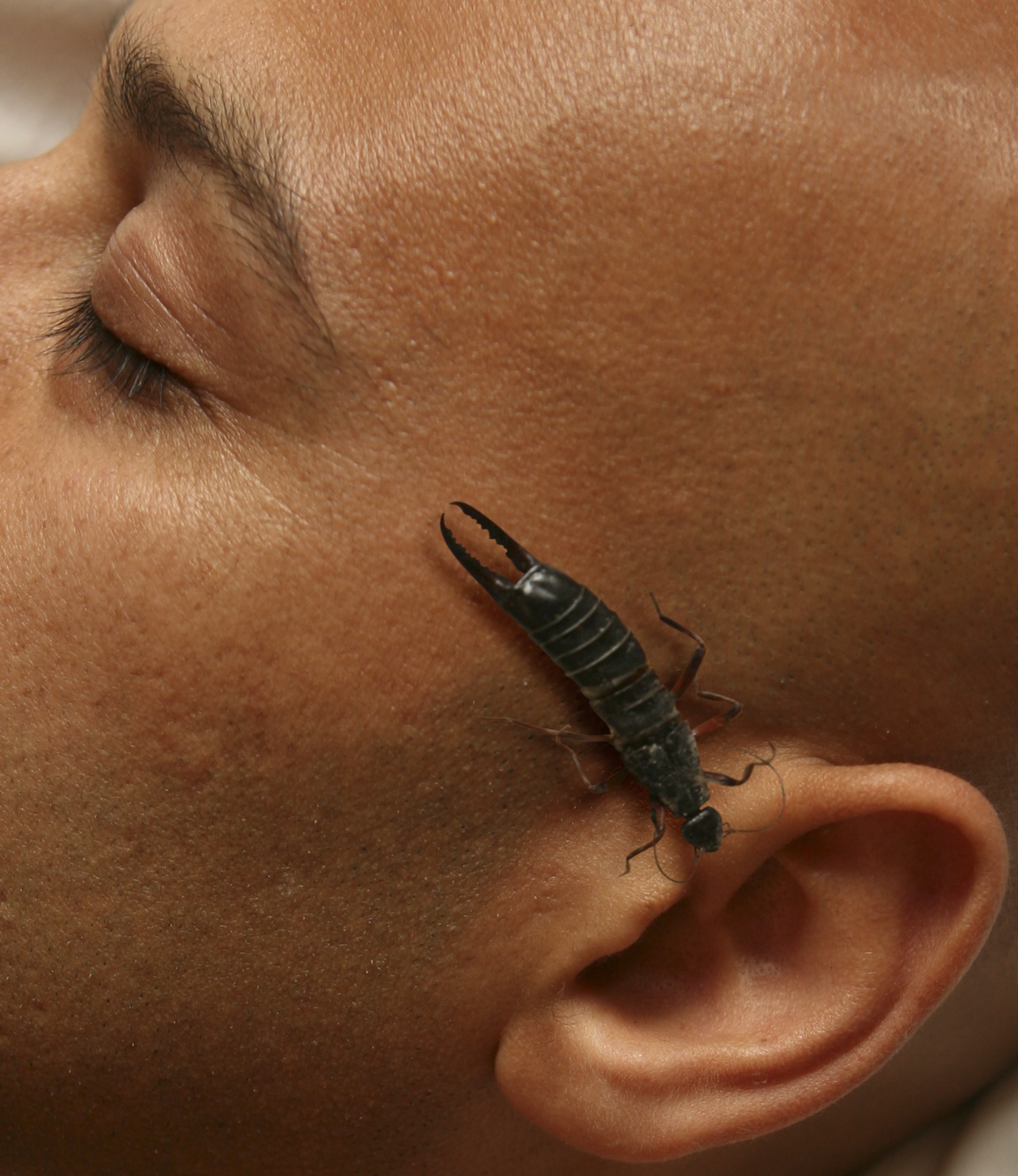 earwig-bite-images-symptoms-marks-treatment-earwig-bite-in-ear