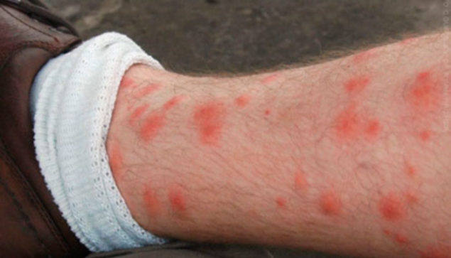 How to get rid of Chiggers and their Bites